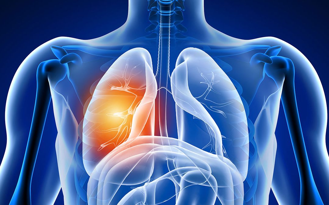 Blood test to detect lung cancer?